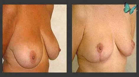 Breast Lift Before and After. Photos show early results. Scars will continue to fade for six months following surgery.