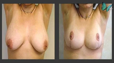 Breast Lift & Reduction Before and After. Photos show early results. Scars will continue to fade for up to six months following surgery.