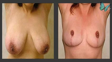 Breast Lift & Reduction Before and After. Photos show early results. Scars will continue to fade for up to six months following surgery.