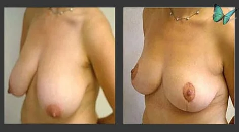 Breast Lift & Reduction Before and After. Photos show early results. Scars will continue to fade for up to six months following surgery.