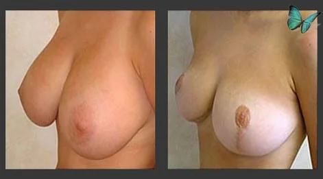 Breast Lift & Reduction Before and After. Photos show early results. Scars will continue to fade for up to six months following surgery.
