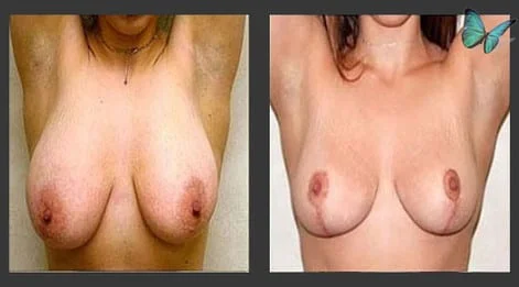 Breast Lift & Reduction Before and After. Photos show early results. Scars will continue to fade for up to six months following surgery.