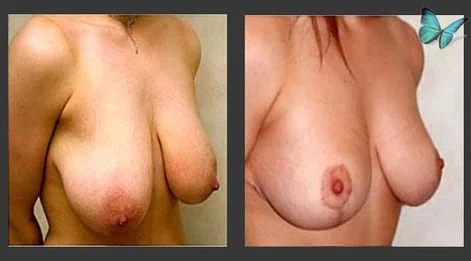 Breast Lift & Reduction Before and After. Photos show early results. Scars will continue to fade for up to six months following surgery.