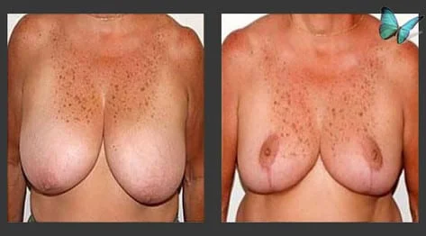 Breast Reduction Before and After