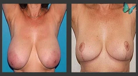 Breast Lift & Reduction Before and After with reduction and restoration of enlarged nipples.
