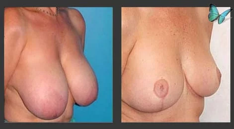 Breast Lift & Reduction Before and After with reduction and restoration of enlarged nipples.