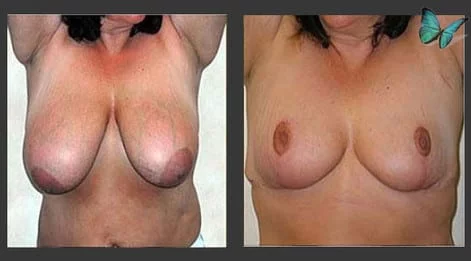 Breast Lift & Reduction Before and After with reduction and restoration of enlarged nipples.