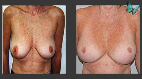 Breast Lift Before and After