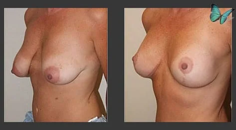Breast Lift Before and After