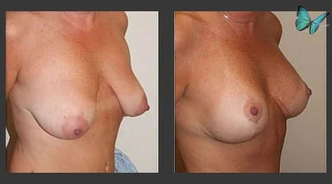 Breast Lift Before and After