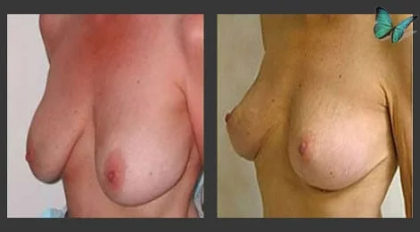 Breast Lift Before and After
