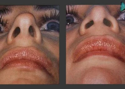 Scarless Rhinoplasty Before and After by Leading Los Angeles Rhinoplasty Surgeon in Beverly Hills Dr. Malcolm Lesavoy.