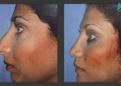 Scarless Rhinoplasty Before and After by Leading Los Angeles Rhinoplasty Surgeon in Beverly Hills Dr. Malcolm Lesavoy.