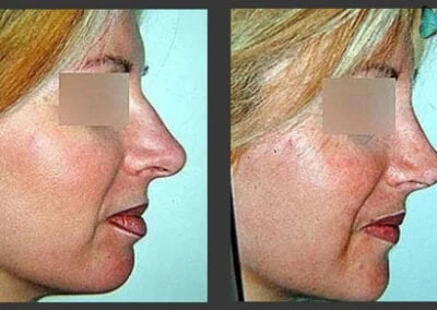 Scarless Rhinoplasty Before and After by Leading Los Angeles Rhinoplasty Surgeon in Beverly Hills Dr. Malcolm Lesavoy.