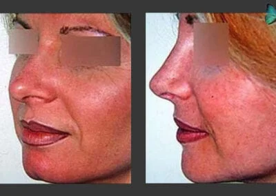 Scarless Rhinoplasty Before and After by Leading Los Angeles Rhinoplasty Surgeon in Beverly Hills Dr. Malcolm Lesavoy.