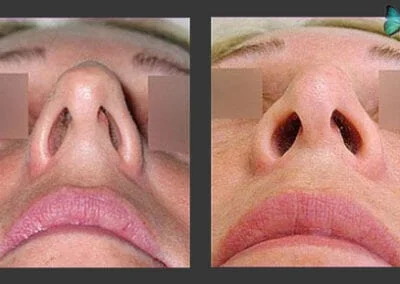 Scarless Rhinoplasty Before and After by Leading Los Angeles Rhinoplasty Surgeon in Beverly Hills Dr. Malcolm Lesavoy.