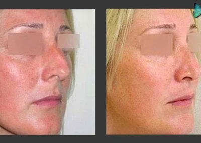 Scarless Rhinoplasty Before and After by Leading Los Angeles Rhinoplasty Surgeon in Beverly Hills Dr. Malcolm Lesavoy.