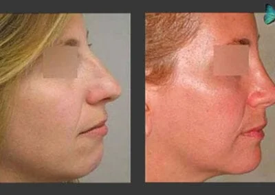 Scarless Rhinoplasty Before and After by Leading Los Angeles Rhinoplasty Surgeon in Beverly Hills Dr. Malcolm Lesavoy.