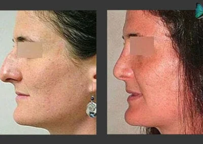 Scarless Rhinoplasty Before and After by Leading Los Angeles Rhinoplasty Surgeon in Beverly Hills Dr. Malcolm Lesavoy.