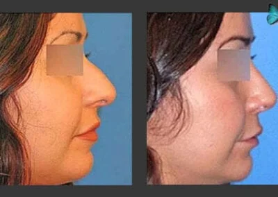 Scarless Rhinoplasty Before and After by Leading Los Angeles Rhinoplasty Surgeon in Beverly Hills Dr. Malcolm Lesavoy.