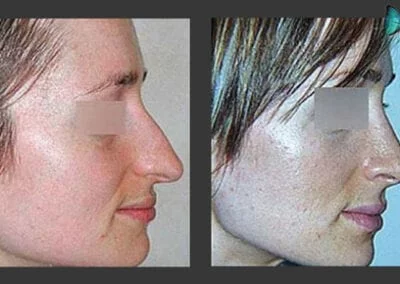 Scarless Rhinoplasty Before and After by Leading Los Angeles Rhinoplasty Surgeon in Beverly Hills Dr. Malcolm Lesavoy.