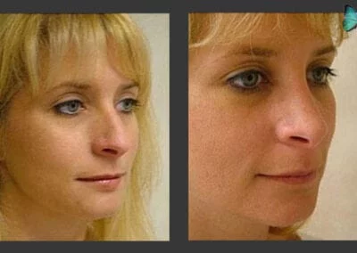 Scarless Rhinoplasty Before and After by Leading Los Angeles Rhinoplasty Surgeon in Beverly Hills Dr. Malcolm Lesavoy.