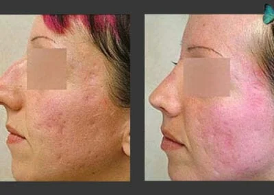 Scarless Rhinoplasty Before and After by Leading Los Angeles Rhinoplasty Surgeon in Beverly Hills Dr. Malcolm Lesavoy.