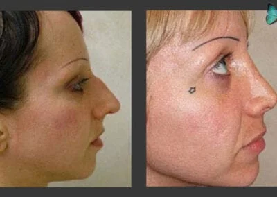 Rhinoplasty before and after photos by Beverly Hills Rhinoplasty Surgeon Dr. Malcolm Lesavoy.