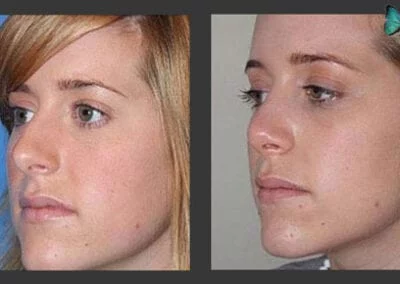 Rhinoplasty before and after photos by Beverly Hills Plastic Surgeon Dr. Malcolm Lesavoy.