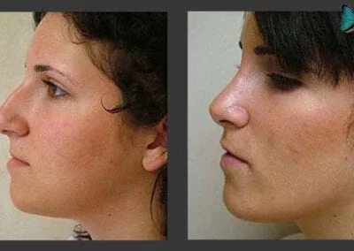 Scarless Rhinoplasty before and after photos by Beverly Hills Plastic Surgeon Dr. Malcolm Lesavoy.