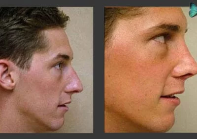 Scarless Rhinoplasty before and after photos by Beverly Hills Plastic Surgeon Dr. Malcolm Lesavoy.