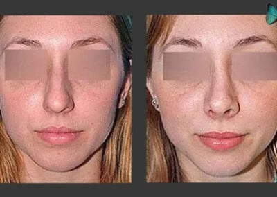 Scarless Rhinoplasty Before and After by Beverly Hills Rhinoplasty specialist surgeon Dr. Malcolm Lesavoy.
