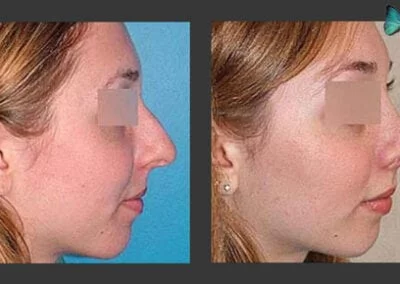 Scarless Rhinoplasty before and after photos by Beverly Hills Rhinoplasty Surgeon Dr. Malcolm Lesavoy.