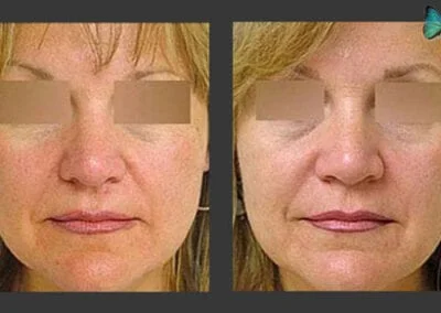 Rhinoplasty Before and After by Beverly Hills Rhinoplasty specialist surgeon Dr. Malcolm Lesavoy.