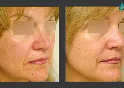 Tip Rhinoplasty before and after photos by Rhinoplasty surgeon Dr. Malcolm Lesavoy.