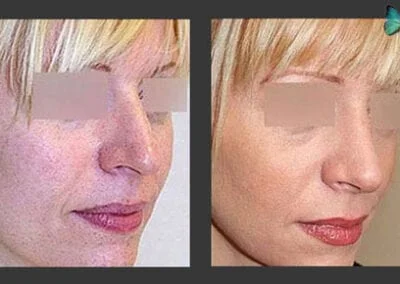 Scarless Rhinoplasty Before and After Photos by Leading Los Angeles Plastic Surgeon in Beverly Hills Dr. Malcolm Lesavoy.