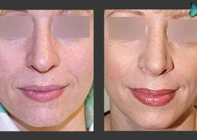 Scarless Rhinoplasty Before and After Photos