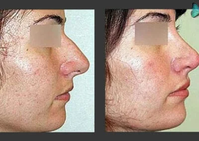 Beverly Hills Rhinoplasty before and after photos by leading scarless Rhinoplasty surgeon Dr. Malcolm Lesavoy.