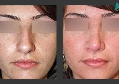 Scarless Rhinoplasty Before and After Photos
