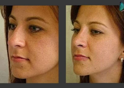 Scarless Rhinoplasty before and after photos by Beverly Hills Rhinoplasty specialist surgeon Dr. Malcolm Lesavoy.