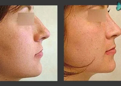 Scarless Rhinoplasty before and after photos by Beverly Hills Rhinoplasty surgeon Dr. Malcolm Lesavoy.