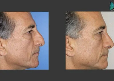 Scarless Rhinoplasty Before and After by Beverly Hills Rhinoplasty surgeon Dr. Malcolm Lesavoy.