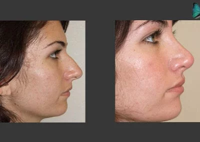 Scarless Rhinoplasty Before and After by Leading Los Angeles Rhinoplasty Surgeon in Beverly Hills Dr. Malcolm Lesavoy.