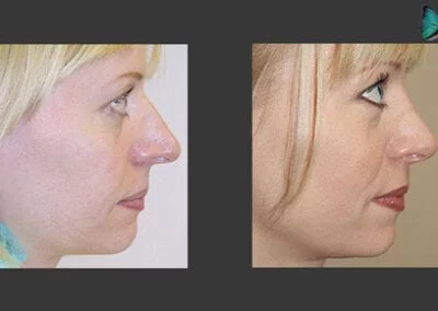 Scarless Rhinoplasty Before and After by Leading Los Angeles Rhinoplasty Surgeon in Beverly Hills Dr. Malcolm Lesavoy.