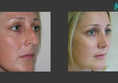Scarless Rhinoplasty Before and After by Leading Los Angeles Rhinoplasty Surgeon in Beverly Hills Dr. Malcolm Lesavoy.