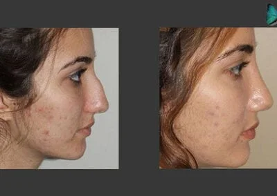 Scarless Rhinoplasty Before and After by Leading Los Angeles Rhinoplasty Surgeon in Beverly Hills Dr. Malcolm Lesavoy.