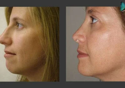 Scarless Rhinoplasty Before and After by Leading Los Angeles Rhinoplasty Surgeon in Beverly Hills Dr. Malcolm Lesavoy.