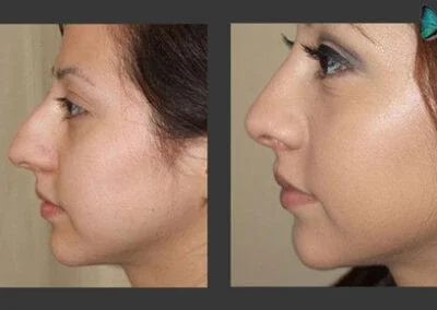 Scarless Rhinoplasty Before and After by Leading Los Angeles Rhinoplasty Surgeon in Beverly Hills Dr. Malcolm Lesavoy.