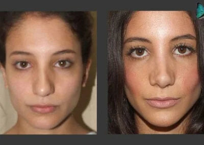 Scarless Rhinoplasty Before and After by Leading Los Angeles Rhinoplasty Surgeon in Beverly Hills Dr. Malcolm Lesavoy.