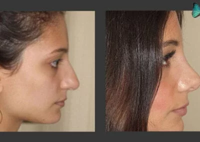 Scarless Rhinoplasty Before and After by Leading Los Angeles Rhinoplasty Surgeon in Beverly Hills Dr. Malcolm Lesavoy.